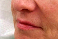 Before Lip-Augmentation-Surgery