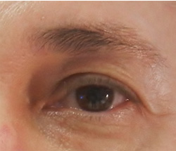 M Khan: Correction of droop on the outer corner of the eye  before