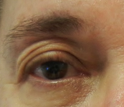 M Khan:Correction of upper eyelid droop before