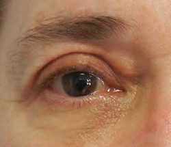 M Khan: Correction of upper eyelid droop  after
