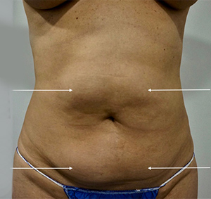 patient photo before Cryolipolysis