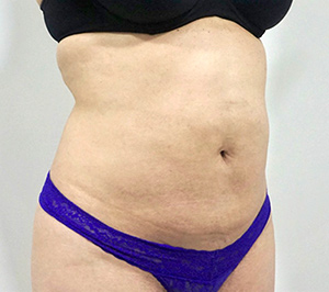 patient photo after Cryolipolysis