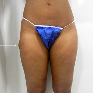 patient photo before Cryolipolysis