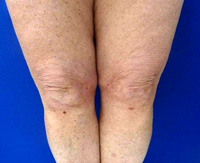 After Knee Contouring