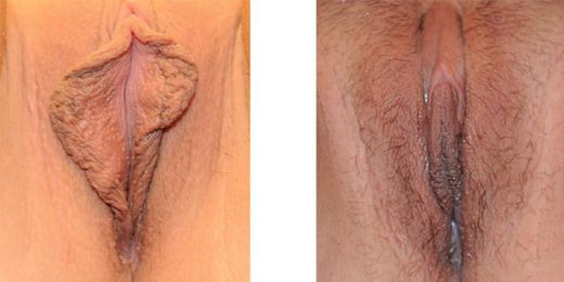 M Khan: labiaplasty procedure